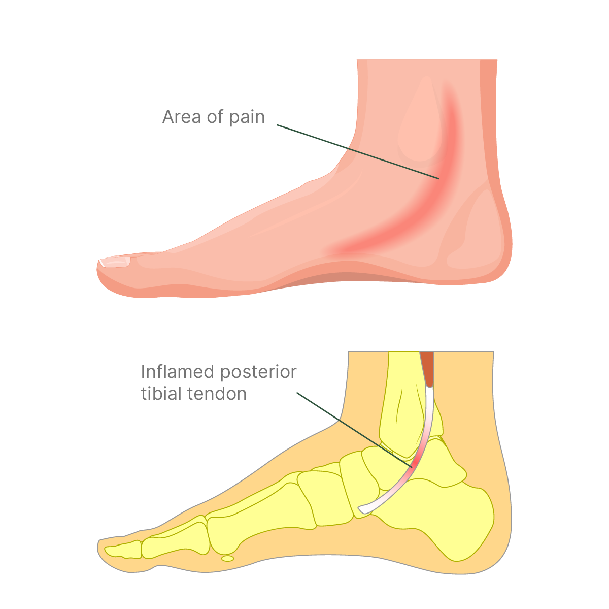 Posterior Tibial Tendon Diagram